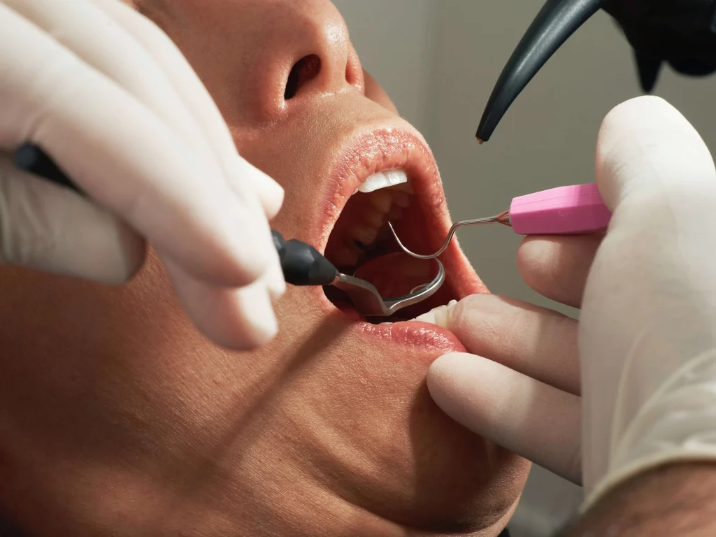 How to safely remove amalgam filling